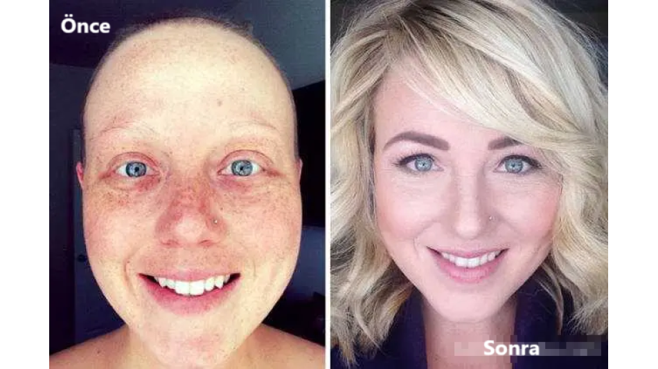 ÇAĞIMIZIN HASTALIĞI KANSER