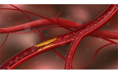 Kanserde Propolis ve Damar Tıkanıklığı